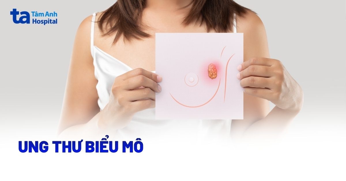 Ung thư biểu mô là gì? Phân loại và tiên lượng