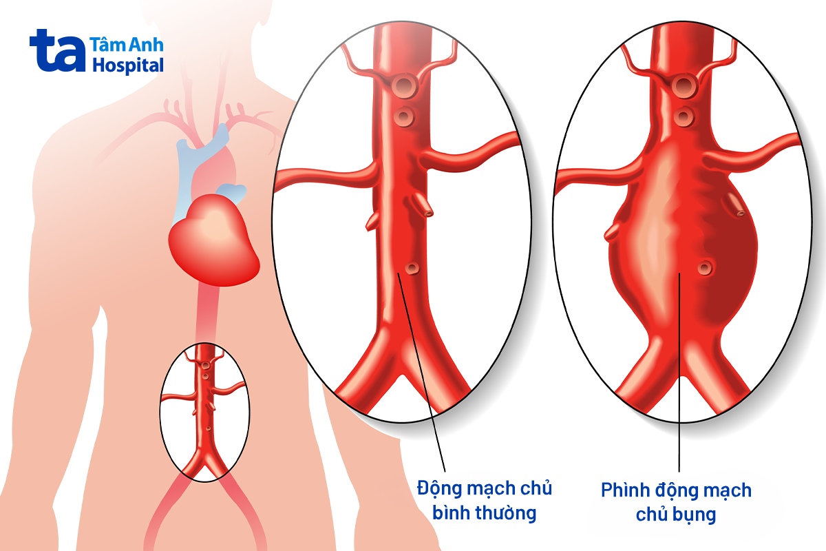 Nguy Cơ Vỡ Túi Phình Động Mạch Chủ 4 Cm