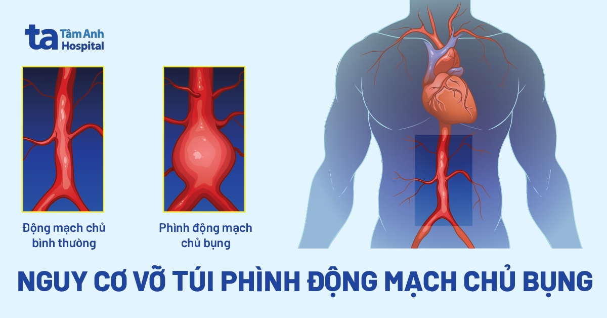 Nguy Cơ Vỡ Túi Phình Động Mạch Chủ Bụng