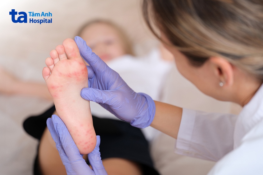 nhiệt miệng khác tay chân miệng