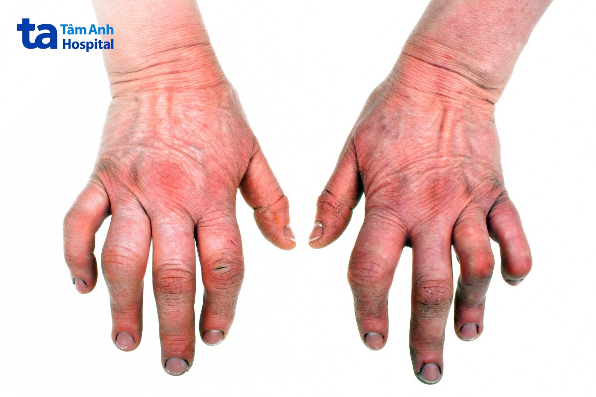 nốt thấp khớp gây khó khăn trong sinh hoạt