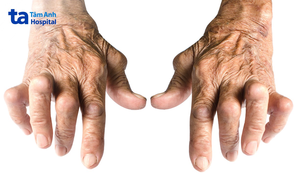 nốt thấp khớp ngón tay do viêm khớp dạng thấp