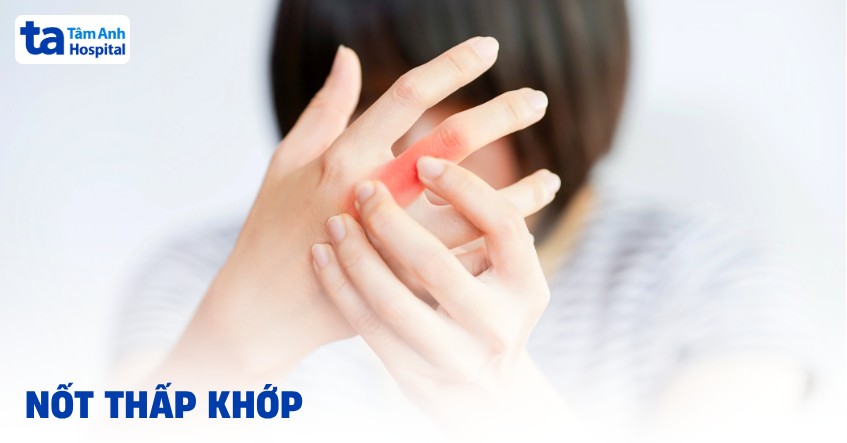 Các nốt thấp khớp là gì? Cơ chế hình thành và khắc phục