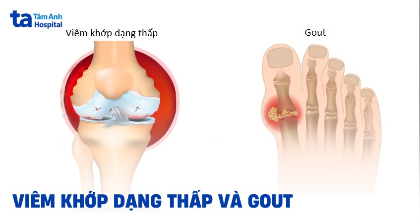 Phân biệt viêm khớp dạng thấp và gout: Giống và khác nhau