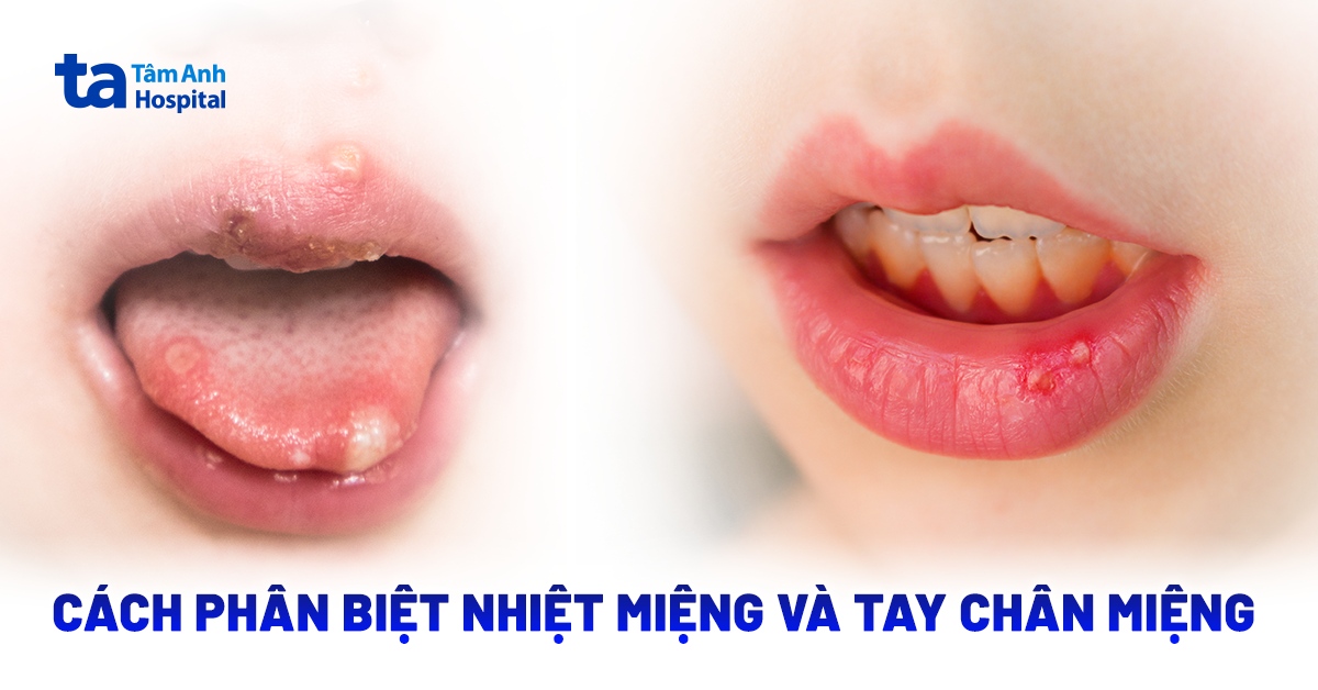 Cách phân biệt nhiệt miệng và tay chân miệng chính xác, dễ dàng