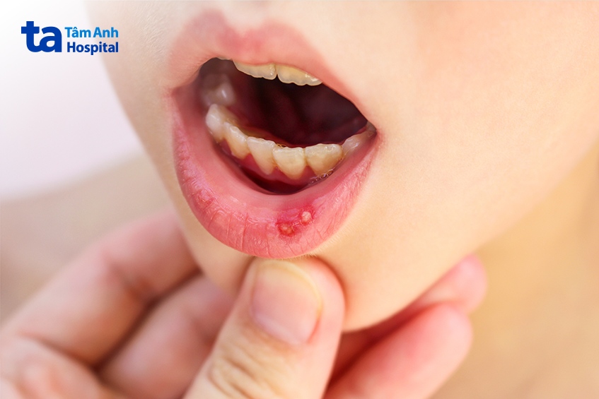 phân biệt tay miệng và nhiệt miệng