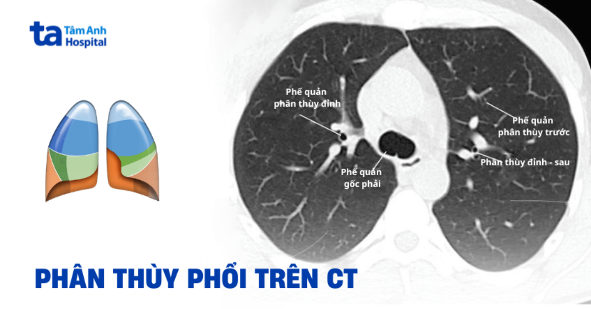 Phân Thùy Phổi Trên Ct
