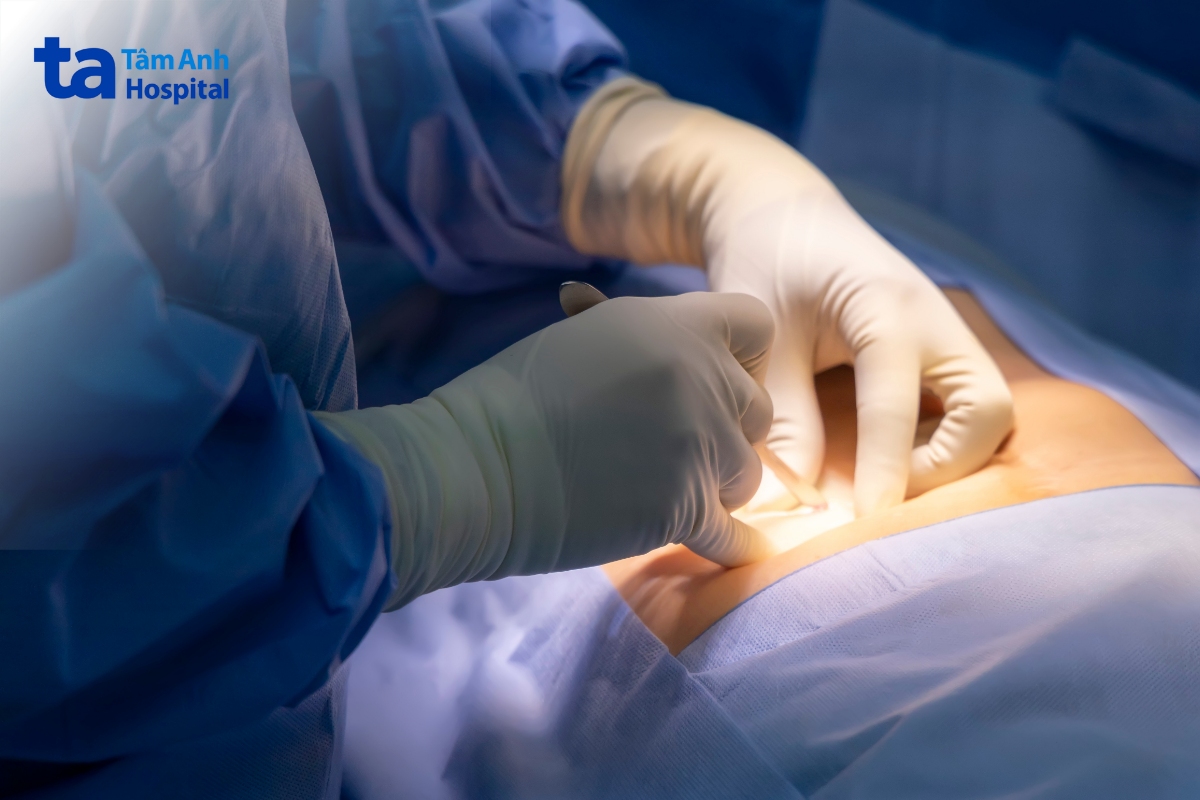 phẫu thuật cắt bỏ phần mỏm cụt