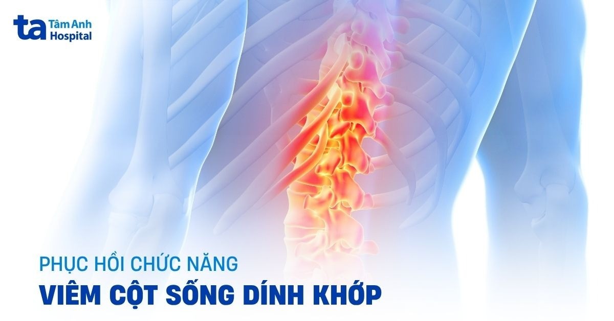 Phục hồi chức năng viêm cột sống dính khớp bằng cách nào?