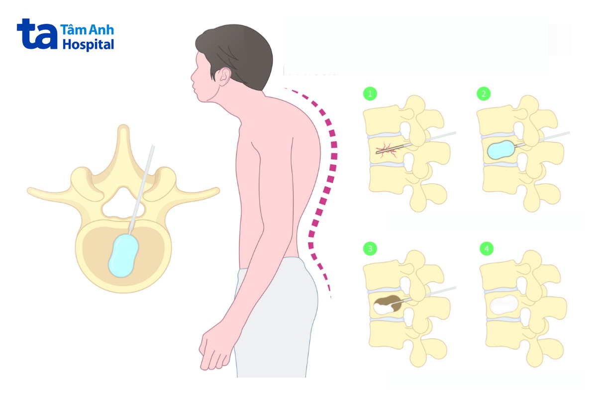 Phương Pháp Thường Được Chỉ Định Để Điều Trị Gãy Xẹp Cột Sống Phương Pháp Thường Được Chỉ Định Để Điều Trị Gãy Xẹp Cột Sống