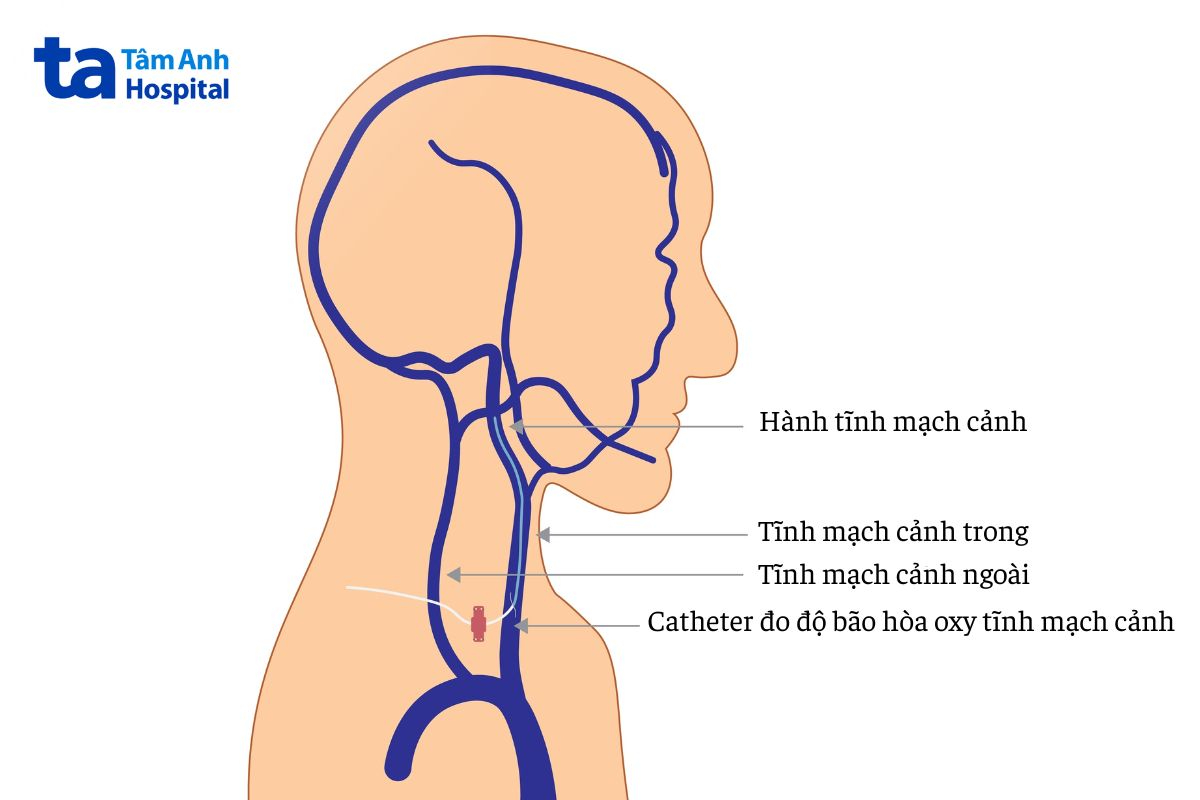 quy trình đo chênh áp tĩnh mạch gan