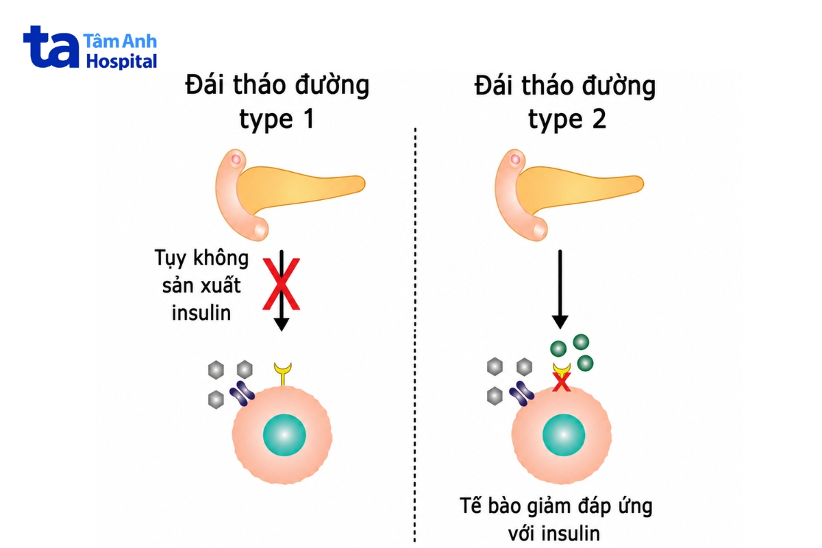 so sánh cơ chế bệnh sinh của đái tháo đường típ 1 và típ 2