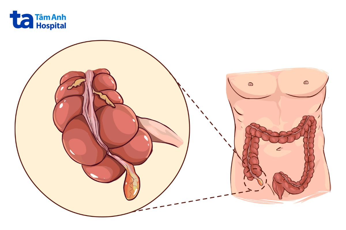 sưng mưng mủ dấu hiệu viêm ruột thừa