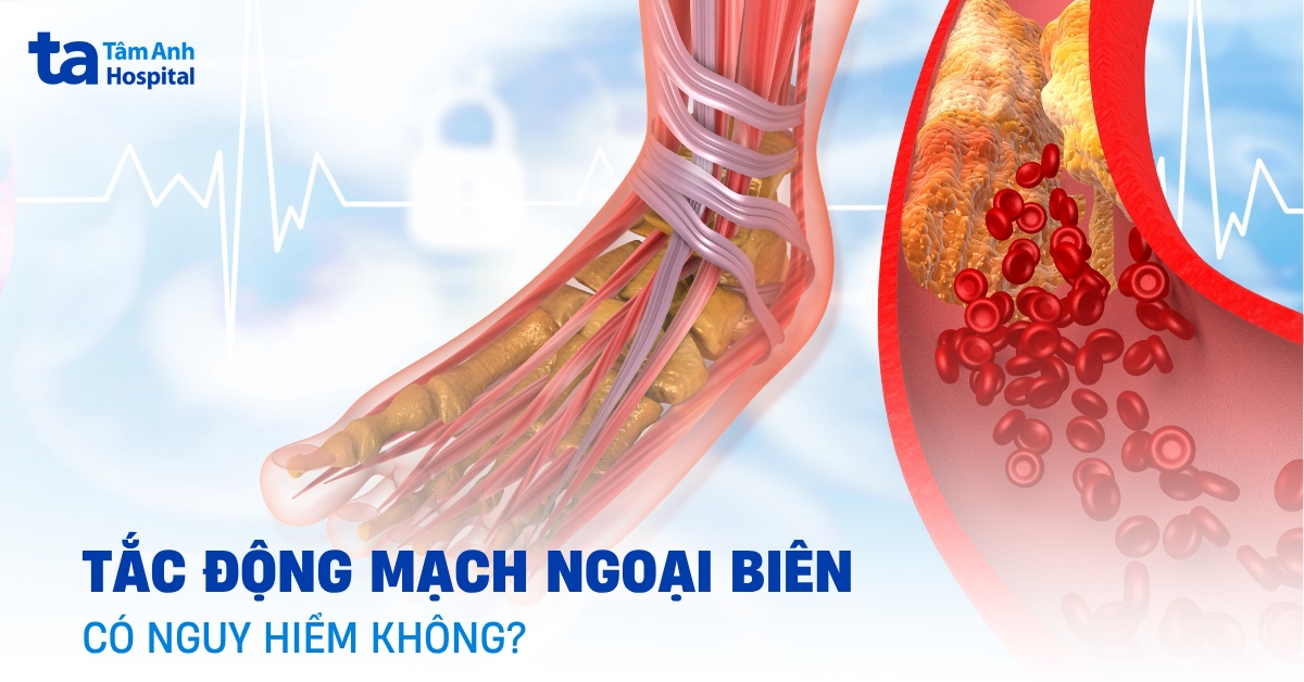 Tắc động mạch ngoại biên: Đâu là hướng xử lý?
