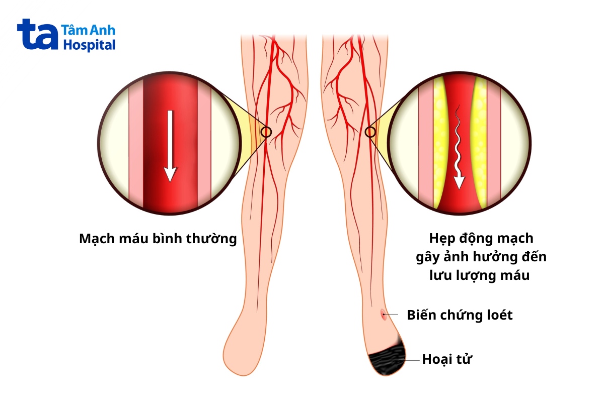 tắc nghẽn động mạch ngoại biên