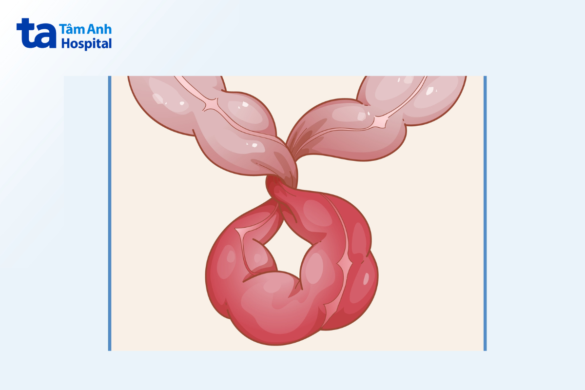 Tắc Ruột Sau Mổ Ruột Thừa