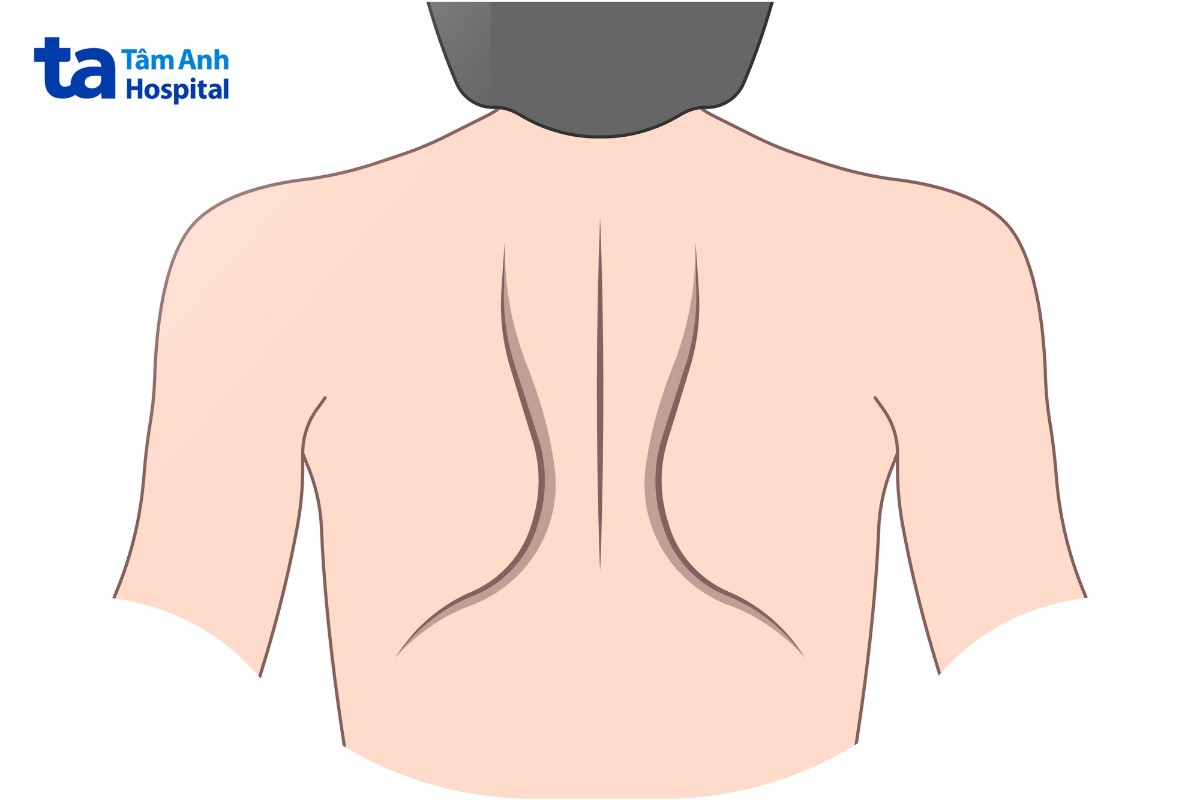 tập ép bả vai tăng cường cơ lưng trên
