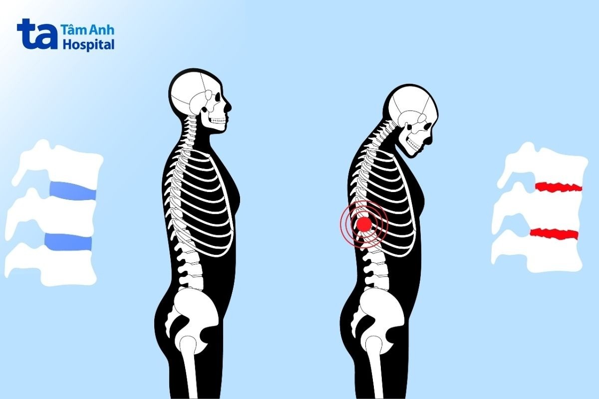tập phục hồi chức năng viêm cột sống dính khớp