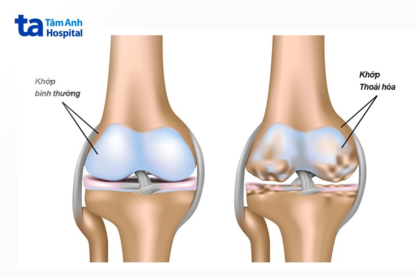 thoái hóa khớp gây biến dạng khớp