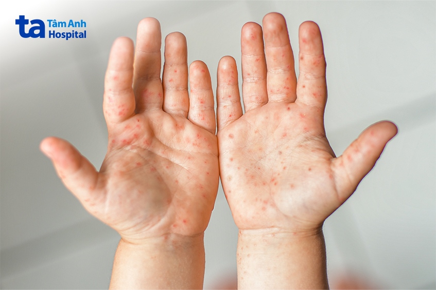 thời gian ủ bệnh tay chân miệng có lây không