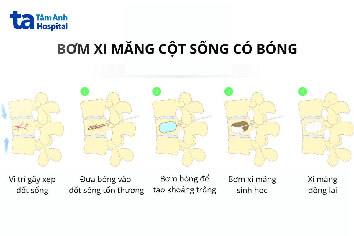 Thủ Thuật Sử Dụng Một Quả Bóng Để Tạo Khoang Trong Thân Đốt Sống Thủ Thuật Sử Dụng Một Quả Bóng Để Tạo Khoang Trong Thân Đốt Sống