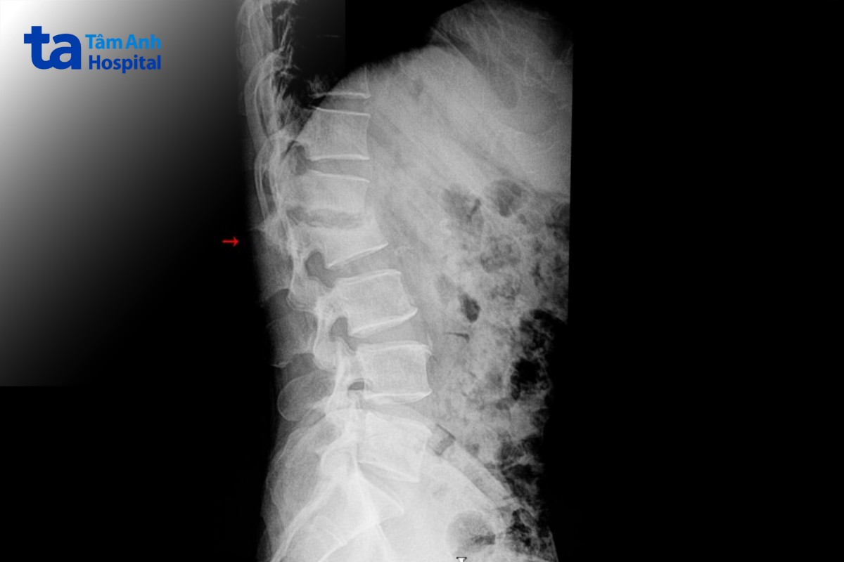 tình trạng cột sống bị xẹp lún