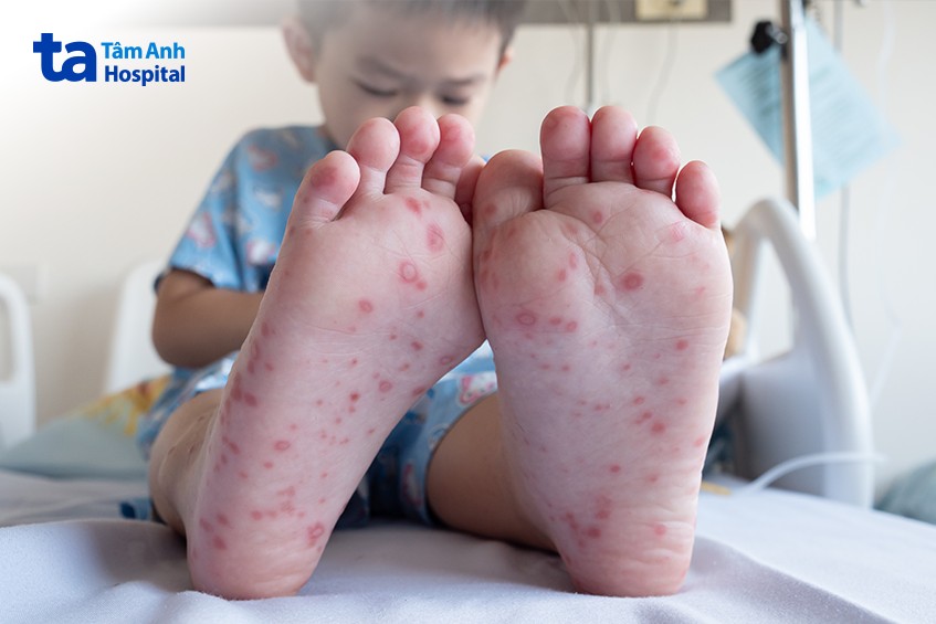 tổn thương lan rộng do chân tay miệng