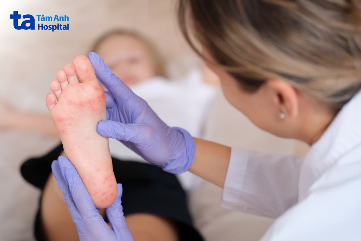 trẻ bị tay chân miệng lần 2 cần được bác sĩ khám và điều trị, chăm sóc