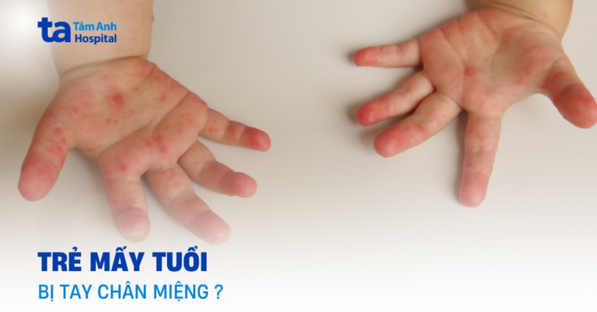 Trẻ mấy tuổi bị tay chân miệng? Độ tuổi nào có nguy cơ cao?