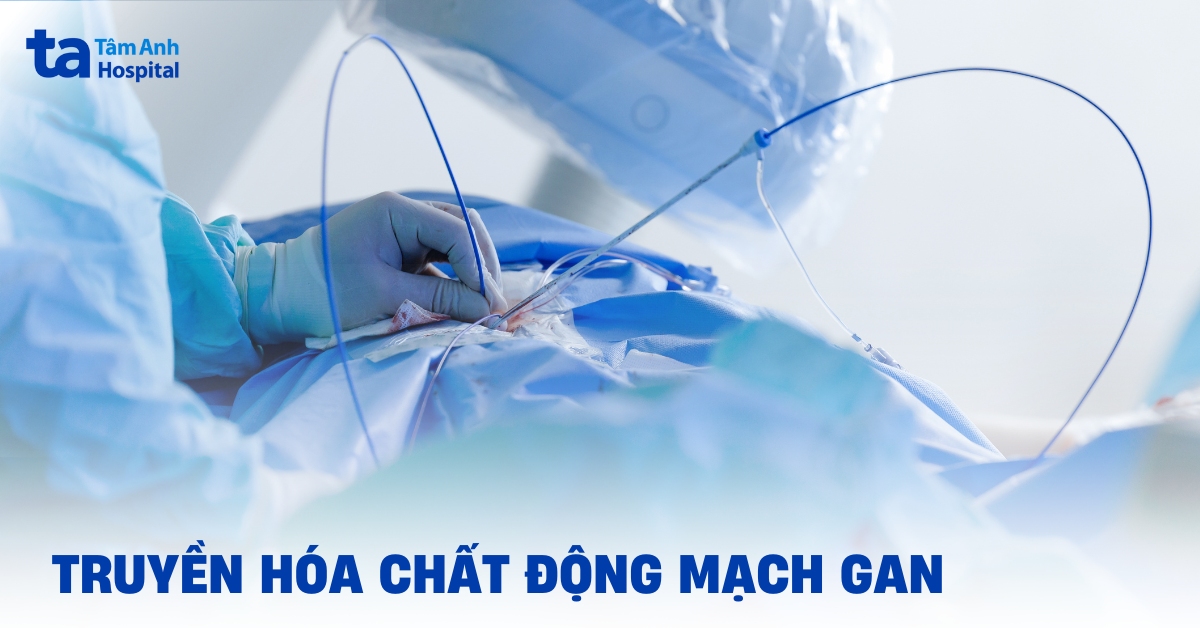 Truyền hóa chất động mạch gan: Quy trình thực hiện
