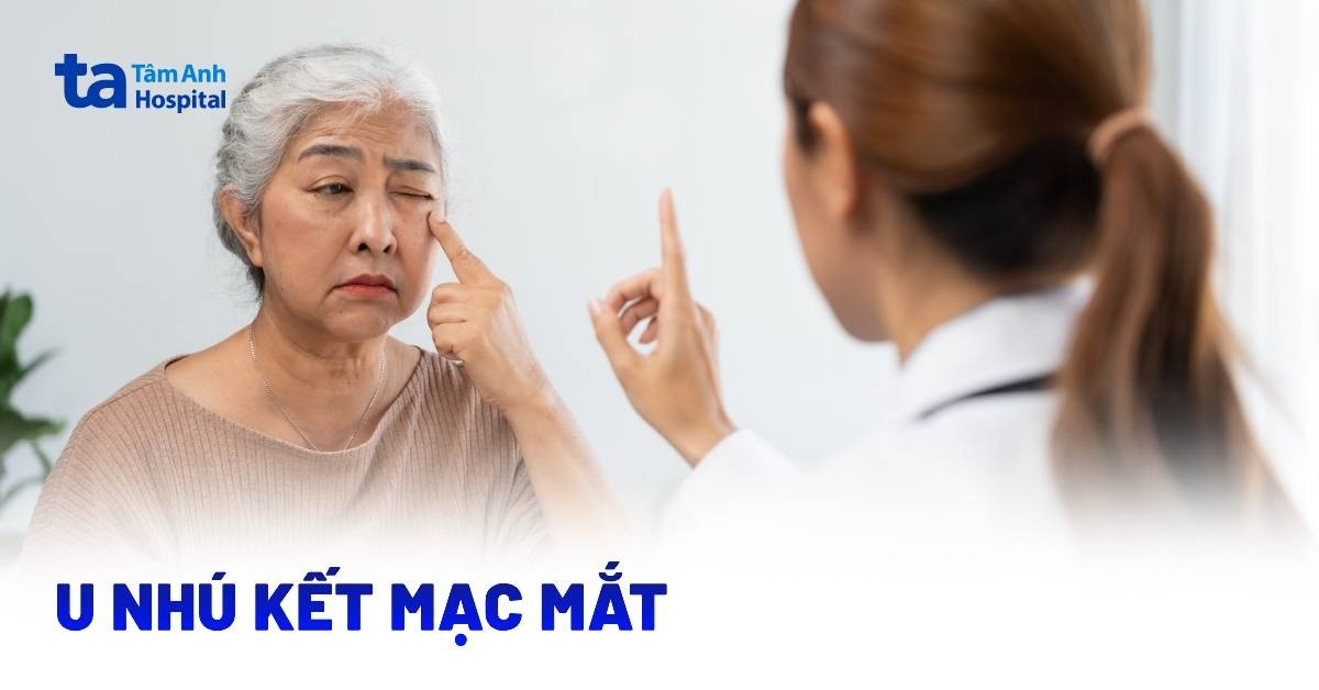 Hiểu rõ về u nhú kết mạc và giải pháp xử trí