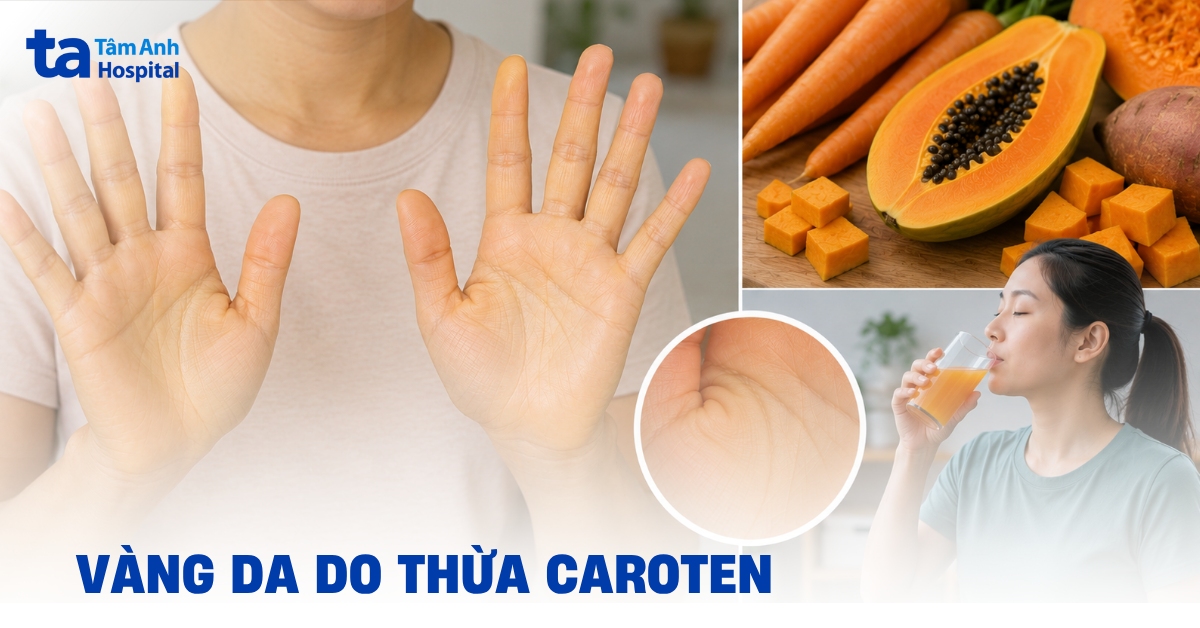 Vàng da do thừa caroten: Cách xử lý và phòng ngừa