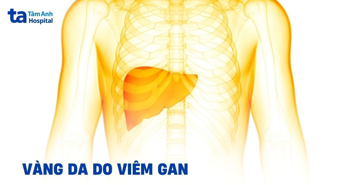 Vàng da do viêm gan: Cơ chế gây bệnh và cách xử lý