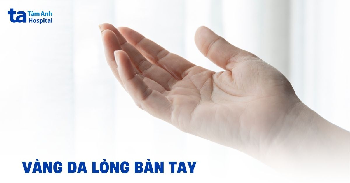 Vàng da lòng bàn tay là bệnh gì? Cách xử lý hiệu quả