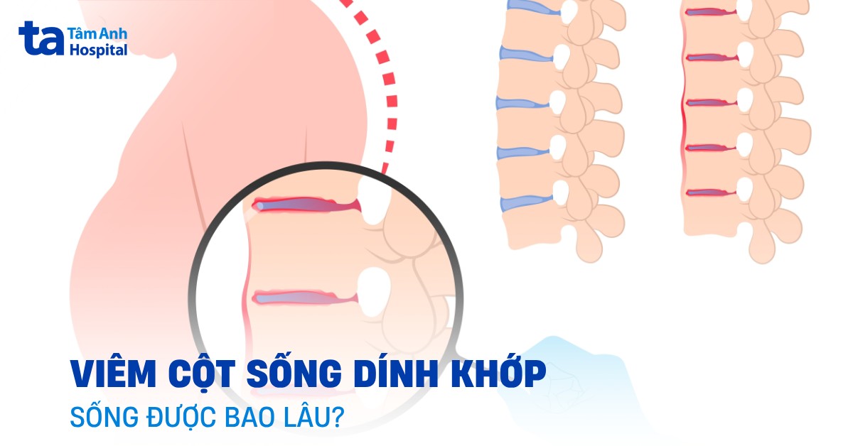 Viêm cột sống dính khớp sống được bao lâu?