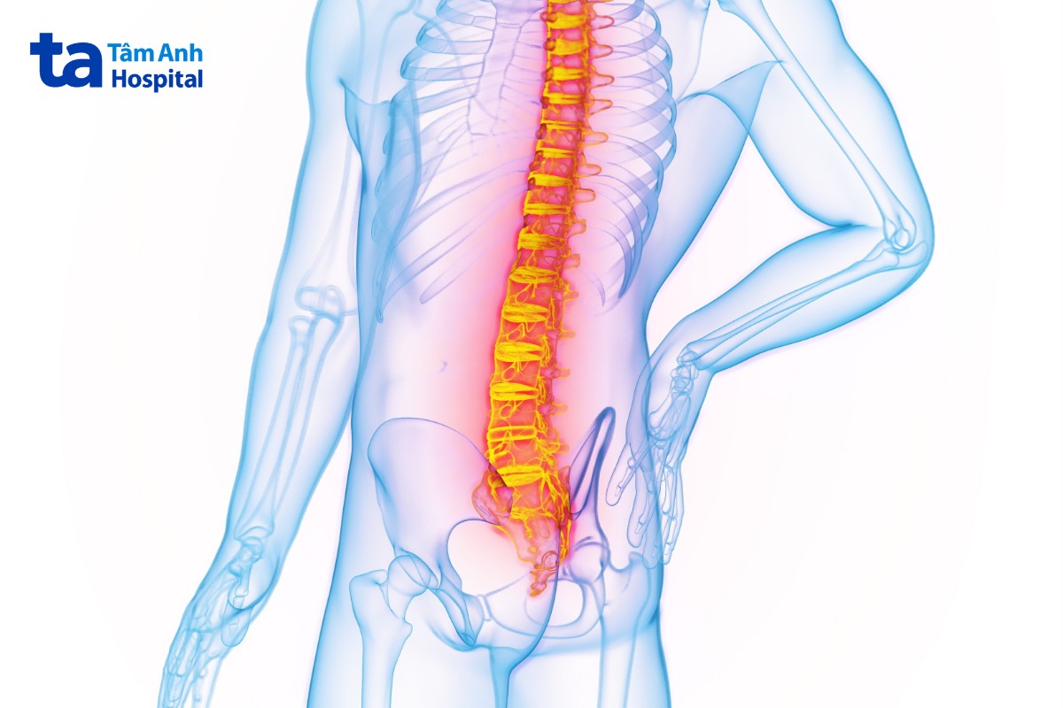 viêm cột sống dính khớp thể trục