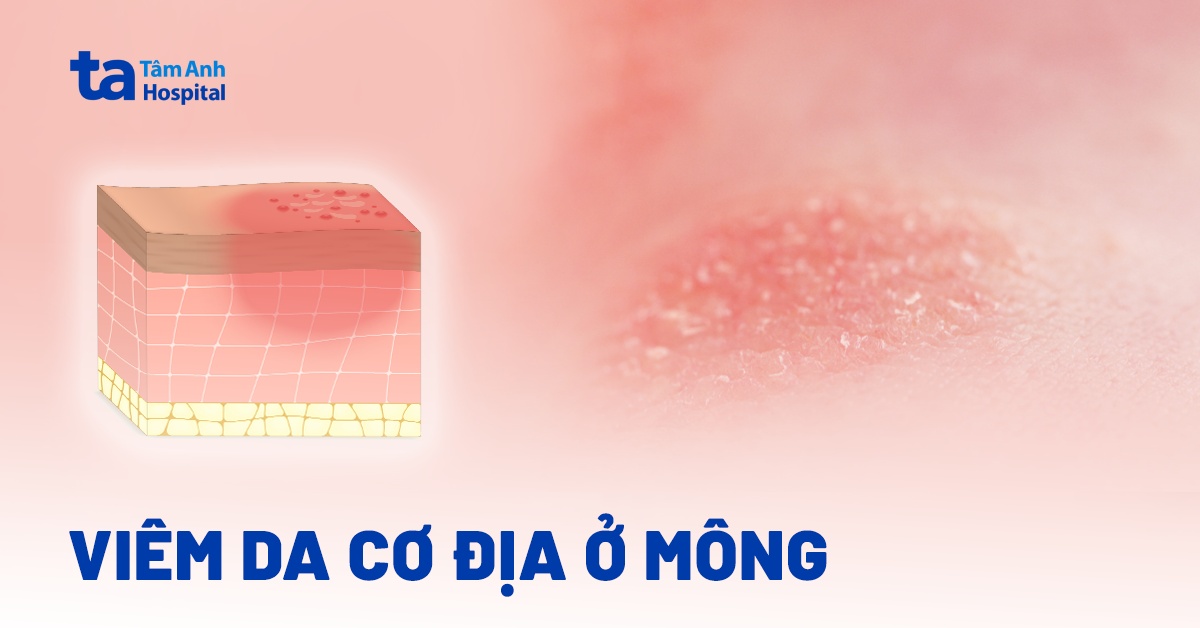Nhận biết viêm da cơ địa ở mông và hướng xử trí