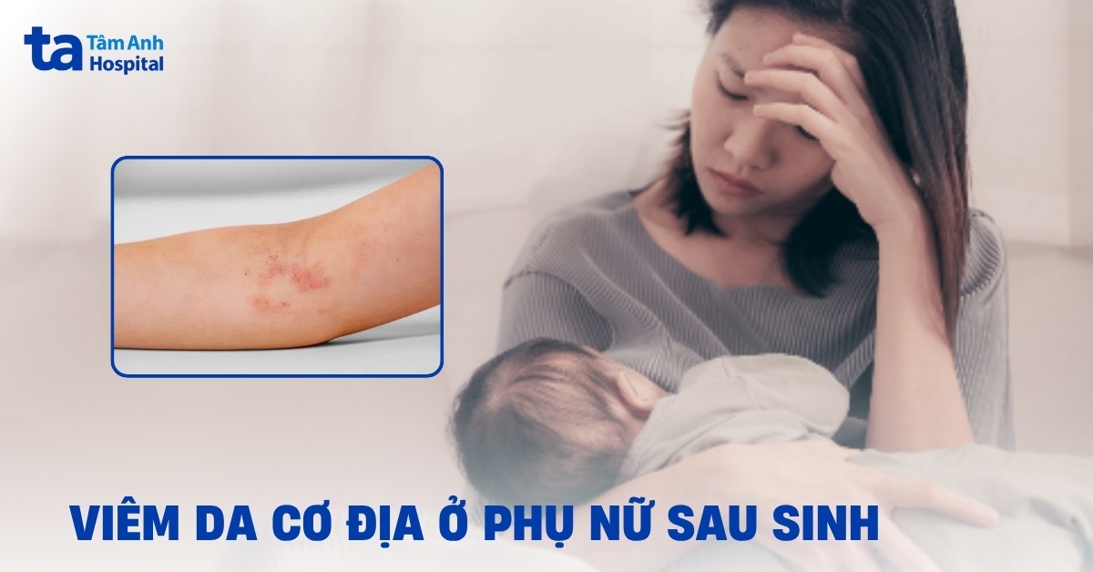 Viêm da cơ địa sau sinh có thể cải thiện được không?
