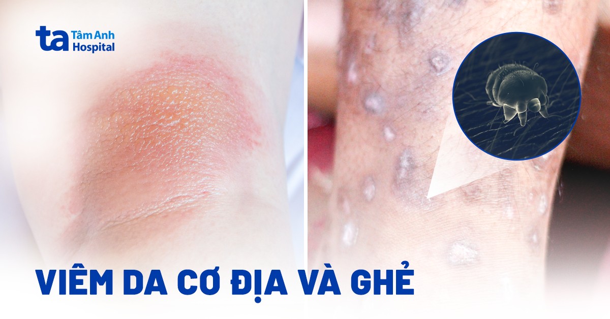 Phân biệt viêm da cơ địa và ghẻ theo bảng chi tiết