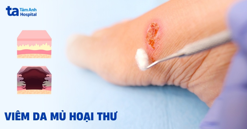 Viêm da mủ hoại thư (Pyoderma gangrenosum)