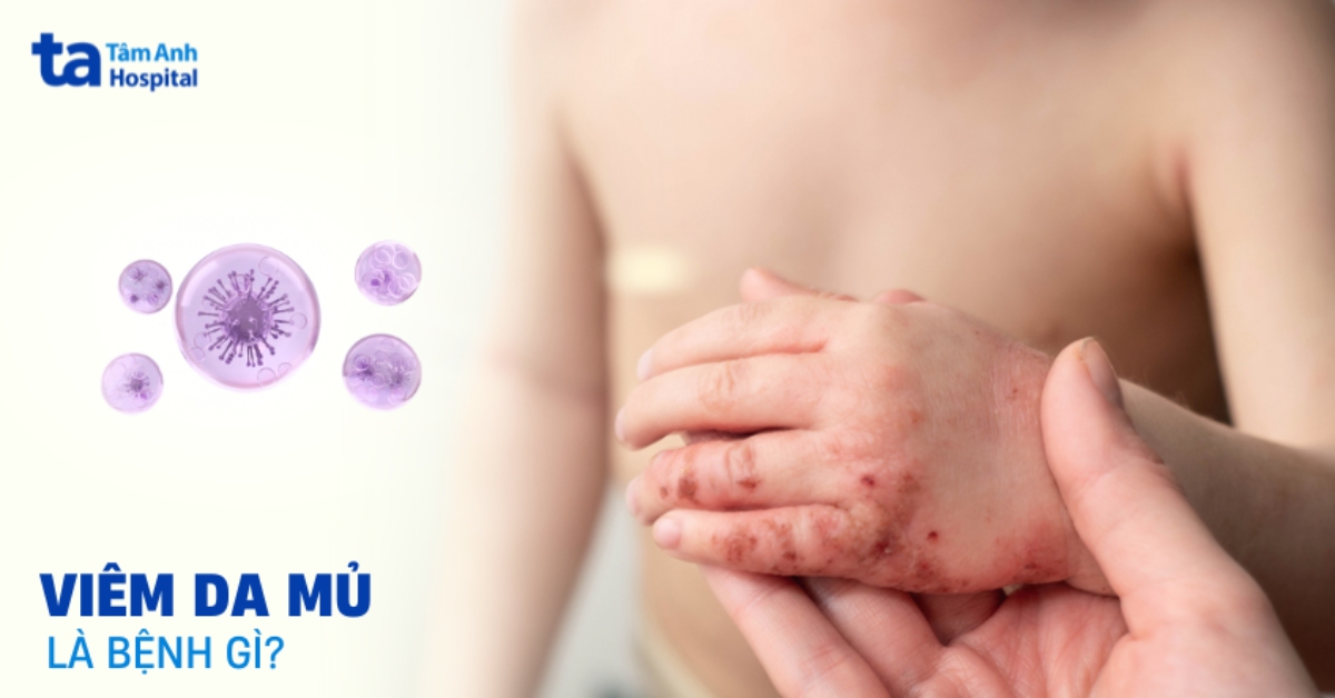 Viêm da mủ: Đặc điểm, mức độ nguy hiểm và cách kiểm soát