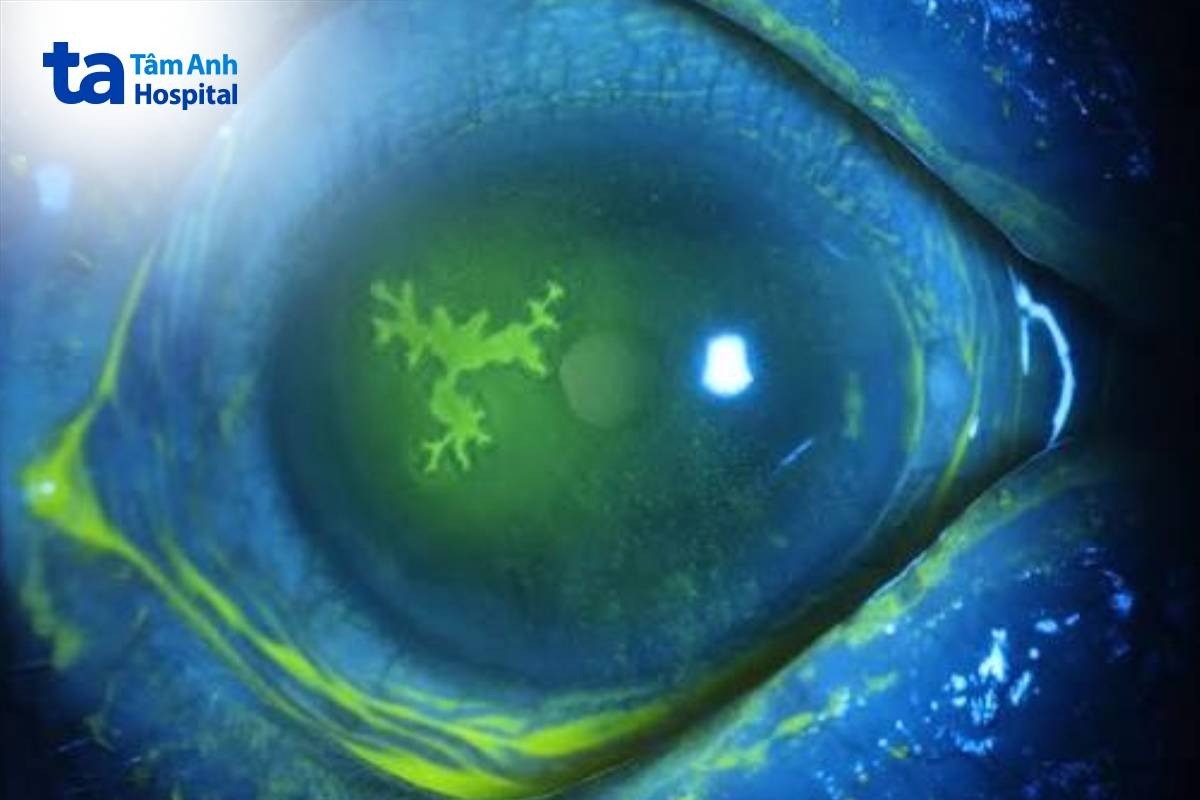 Viêm Giác Mạc Dạng Cành Cây