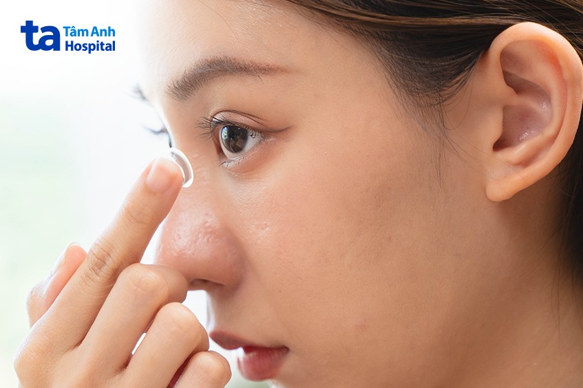 Viêm Giác Mạc Do Vi Khuẩn