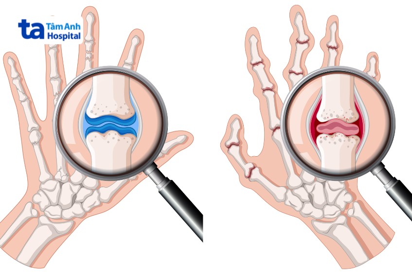 viêm khớp dạng thấp và gout