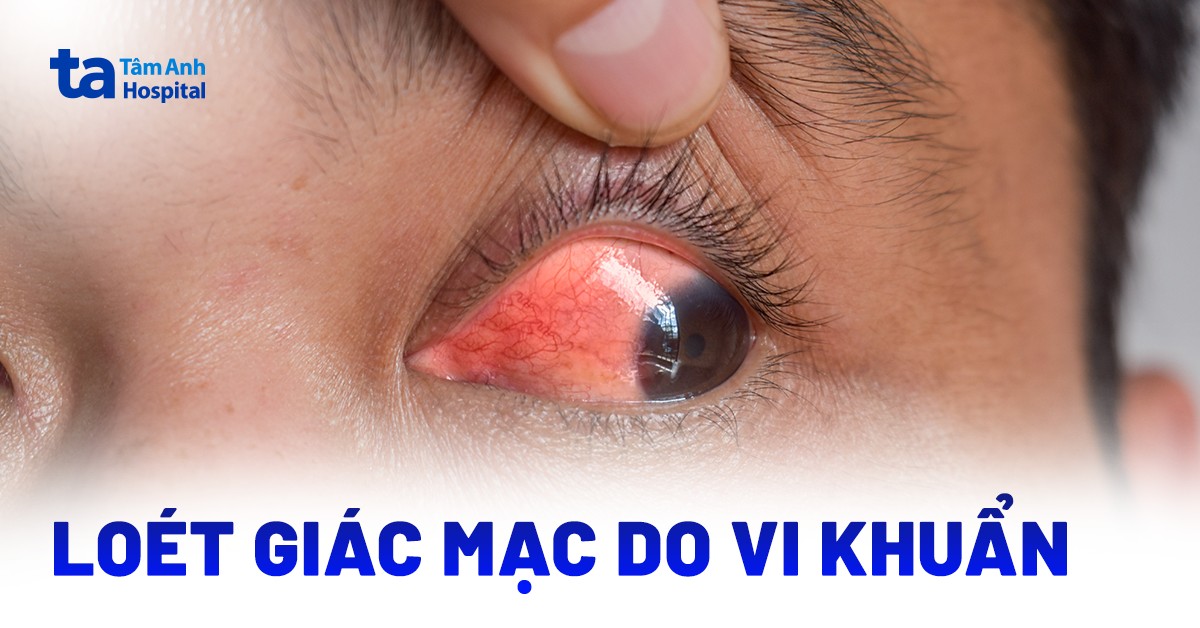 Hiểu đúng về viêm loét giác mạc do vi khuẩn
