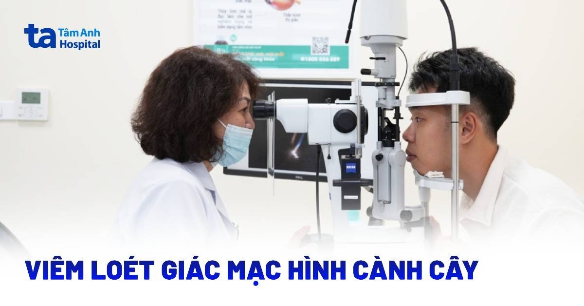 Viêm Loét Giác Mạc Hình Cành Cây
