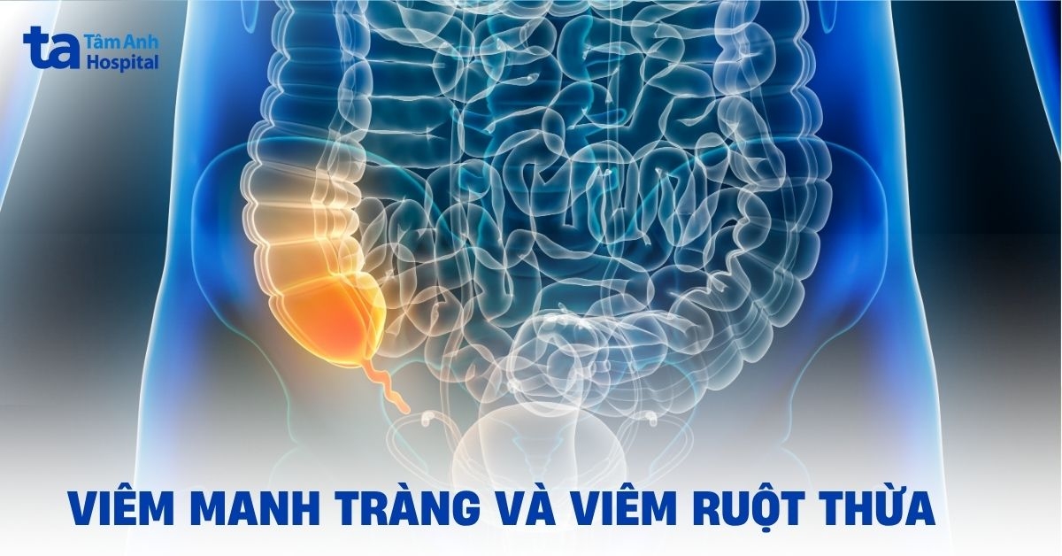 Phân biệt viêm manh tràng và viêm ruột thừa qua triệu chứng