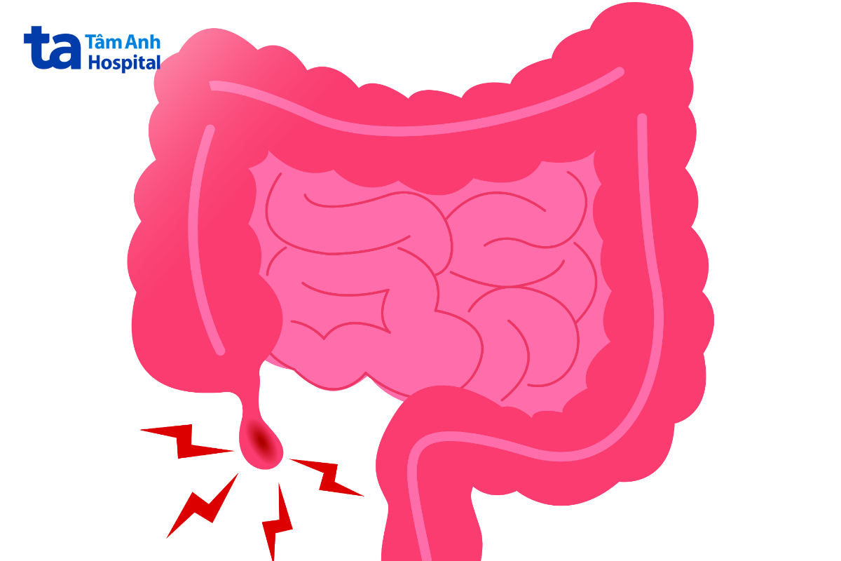 viêm mỏm cụt ruột thừa sau phẫu thuật