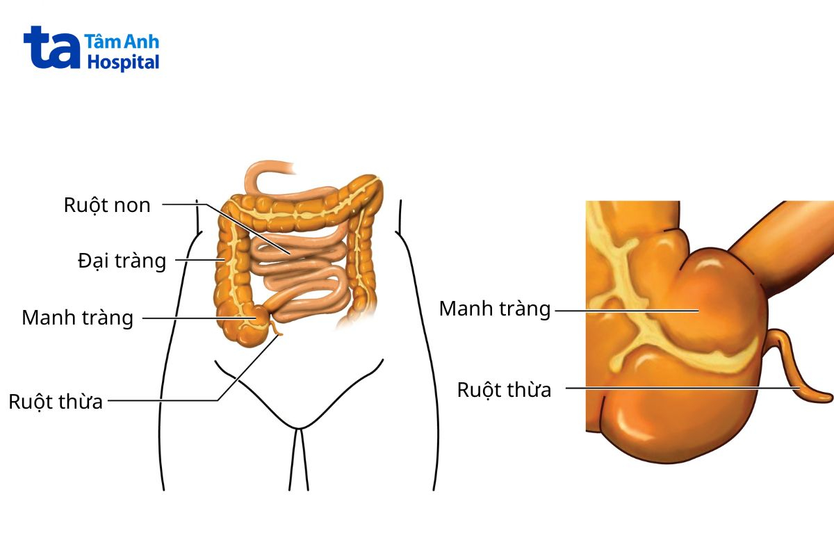 viêm ruột thừa khác viêm manh tràng