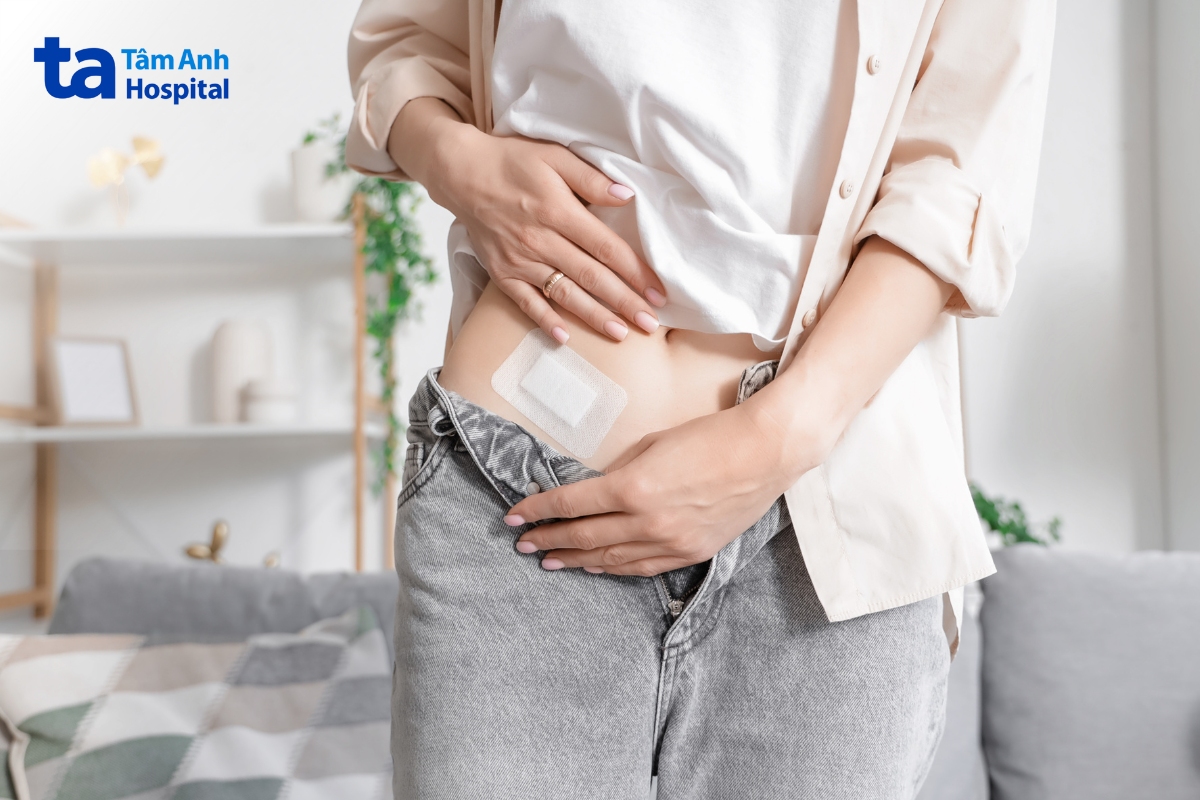 viêm ruột thừa không tái phát sau cắt